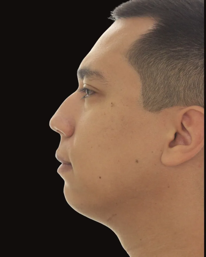 Antes — Mentoplastia