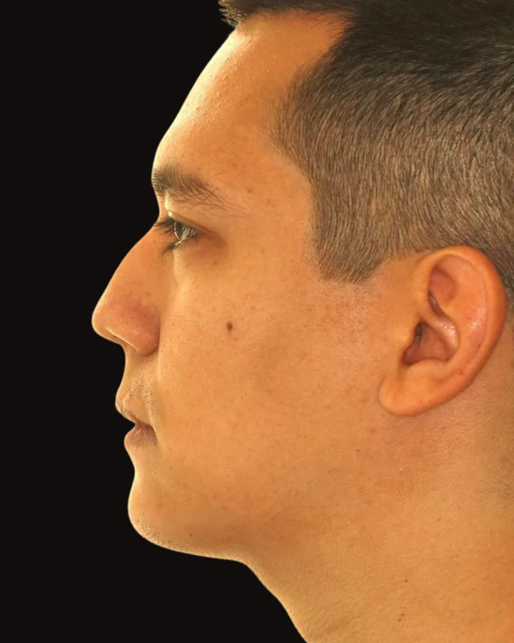 Depois — Mentoplastia