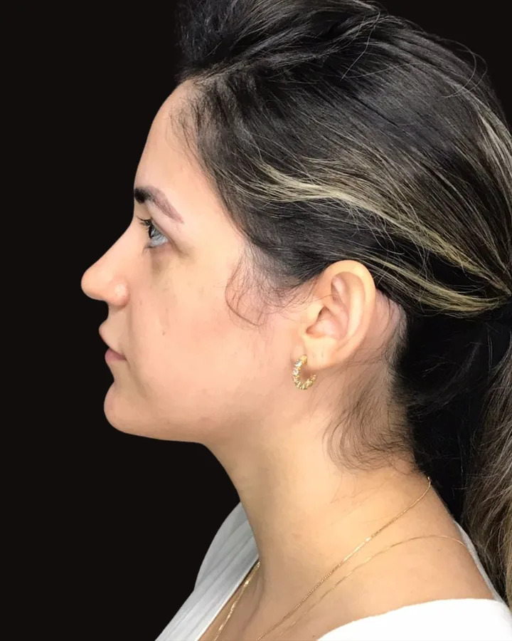 Depois — Cirurgia Ortognática